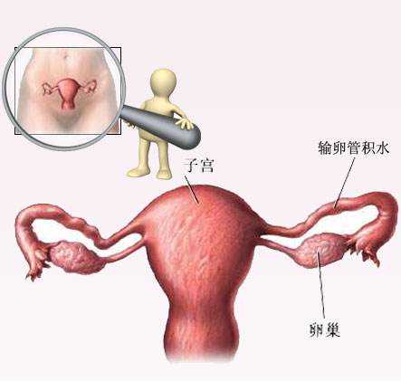 怀孕香港验血多少钱啊, 当美国试管婴儿遇上输卵管积水怎么办?如何处理?