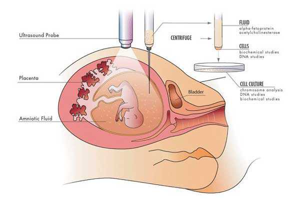 怀孕后做dna验血去香港多少钱,宫腔积液如何影响辅助生殖技术中助孕过程？