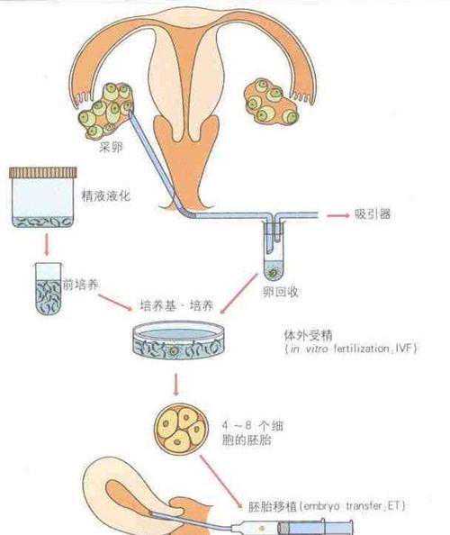 香港 孕妇 验血 原理,试管婴儿孩子有缺陷吗